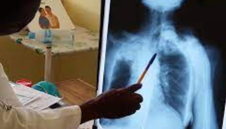 Imagen de la noticia: Aumento de tuberculosis en niños en Venezuela se ha vuelto un problema de salud